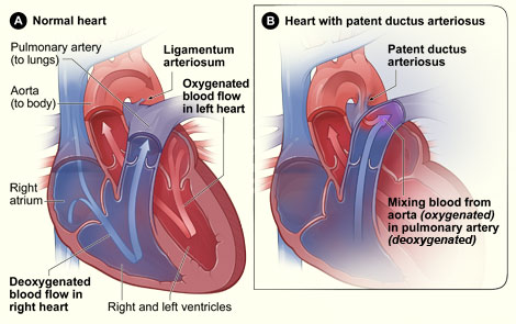 patent_ductus