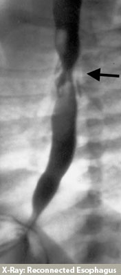 Esophageal Atresia - Xray of reconnection