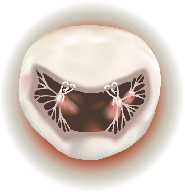 AML Repair2