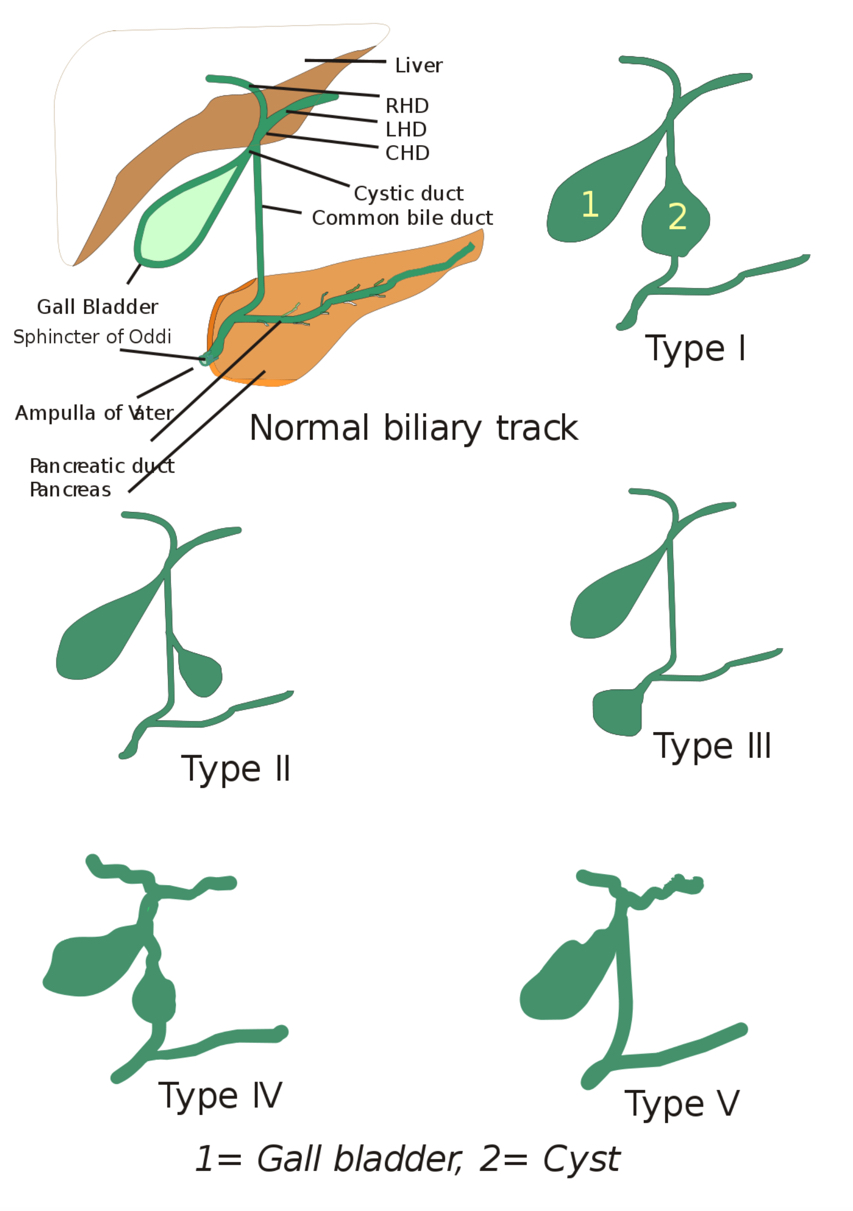 Choledochal Cysts